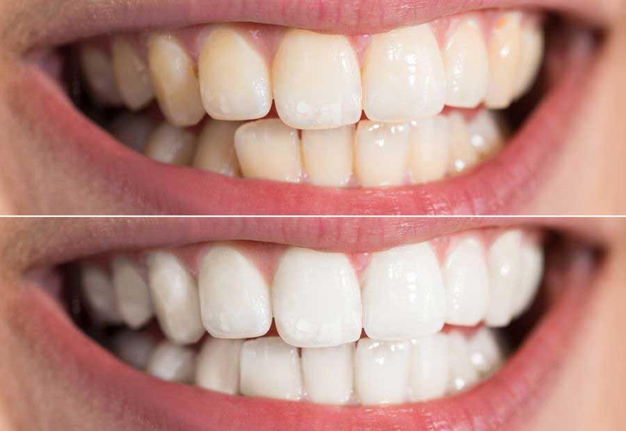 Estetik Diş Uygulamalarında Pembe ve Beyaz Dönemi 