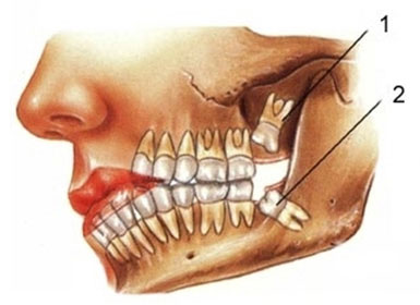 Dişler Neden Ağızda Gömülü Kalır