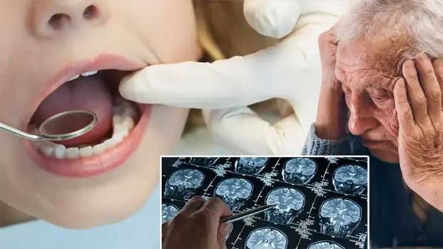 Dişlerinizi İhmal Etmeyin! Alzheimer ile Bağlantısı Ortaya Çıktı Dişlerinizi İhmal Etmeyin! Alzheimer ile Bağlantısı Ortaya Çıktı