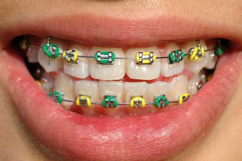 Yetişkinlere Diş Teli Tedavisi Yapılabilir mi